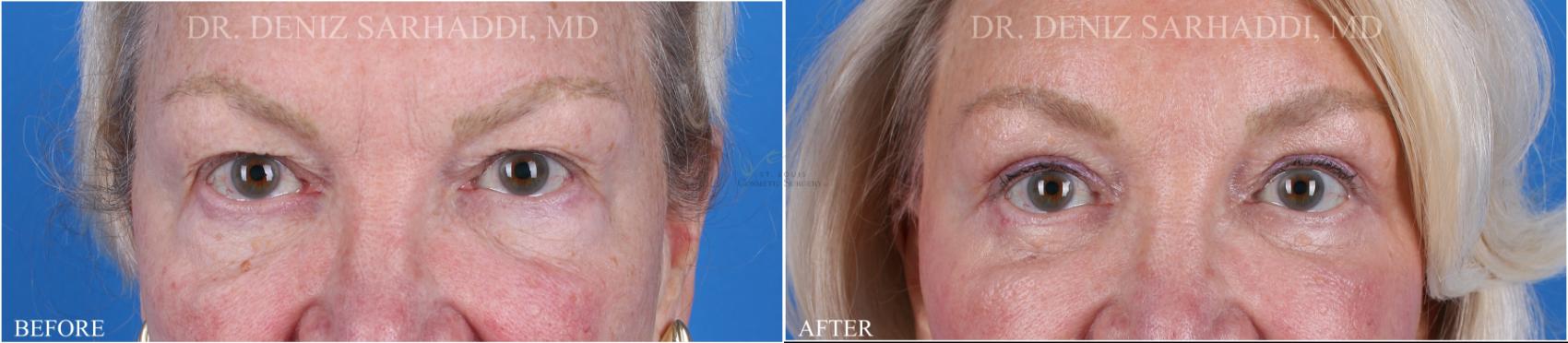 Before & After Eyelid Surgery Case 352 Front View in St. Louis, MO