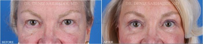 Before & After Eyelid Surgery Case 352 Front View in St. Louis, MO