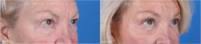 Before & After Eyelid Surgery Case 352 Left Oblique View in St. Louis, MO