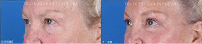 Before & After Eyelid Surgery Case 352 Right Oblique View in St. Louis, MO