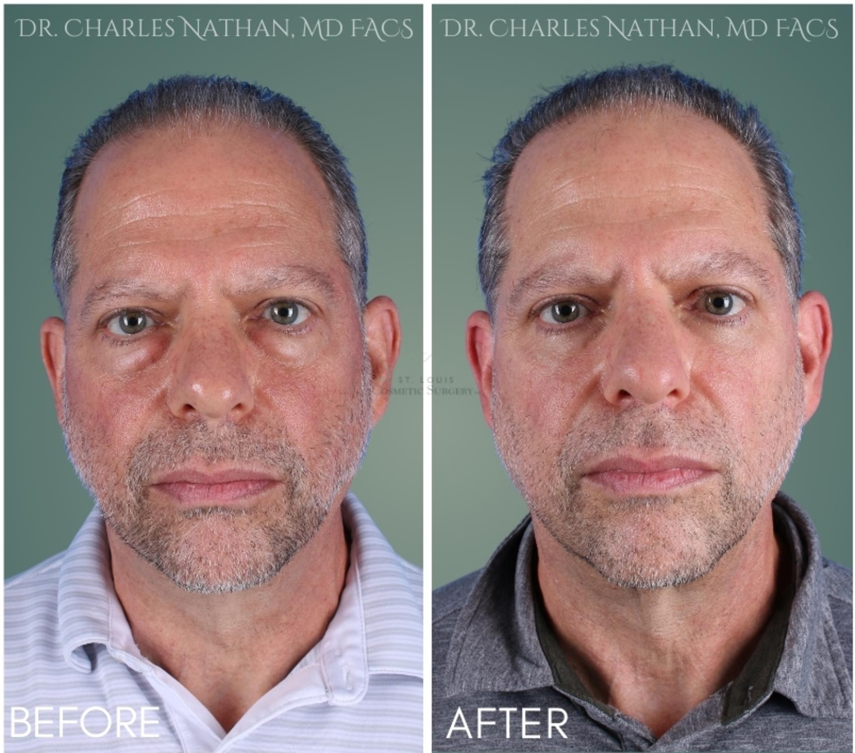 Before & After Eyelid Surgery Case 386 Front View in St. Louis, MO