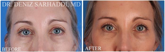 Before & After Eyelid Surgery Case 420 Front View in St. Louis, MO