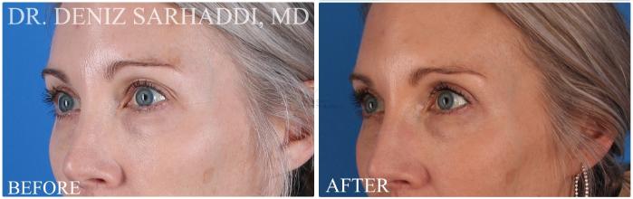 Before & After Eyelid Surgery Case 420 Right Oblique View in St. Louis, MO