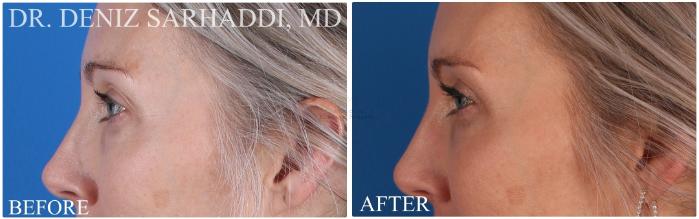 Before & After Eyelid Surgery Case 420 Right Side View in St. Louis, MO
