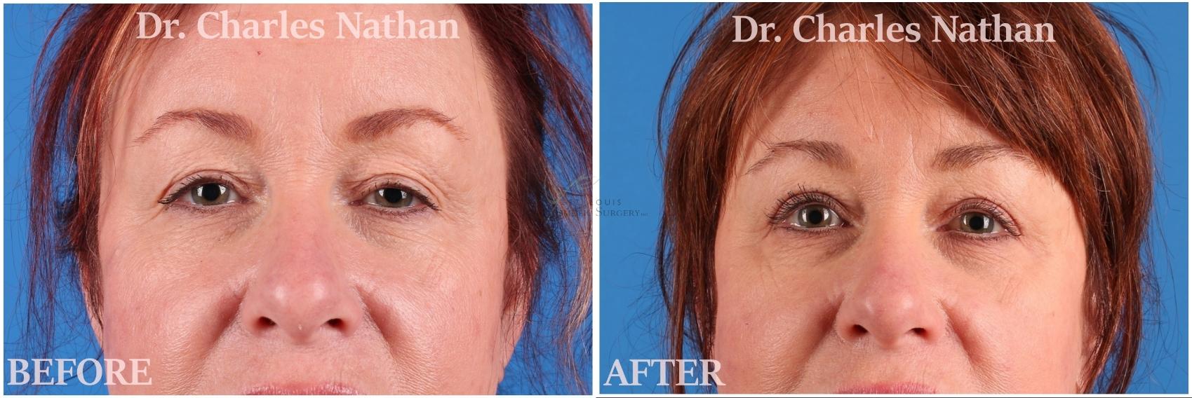 Before & After Eyelid Surgery Case 425 Front View in St. Louis, MO