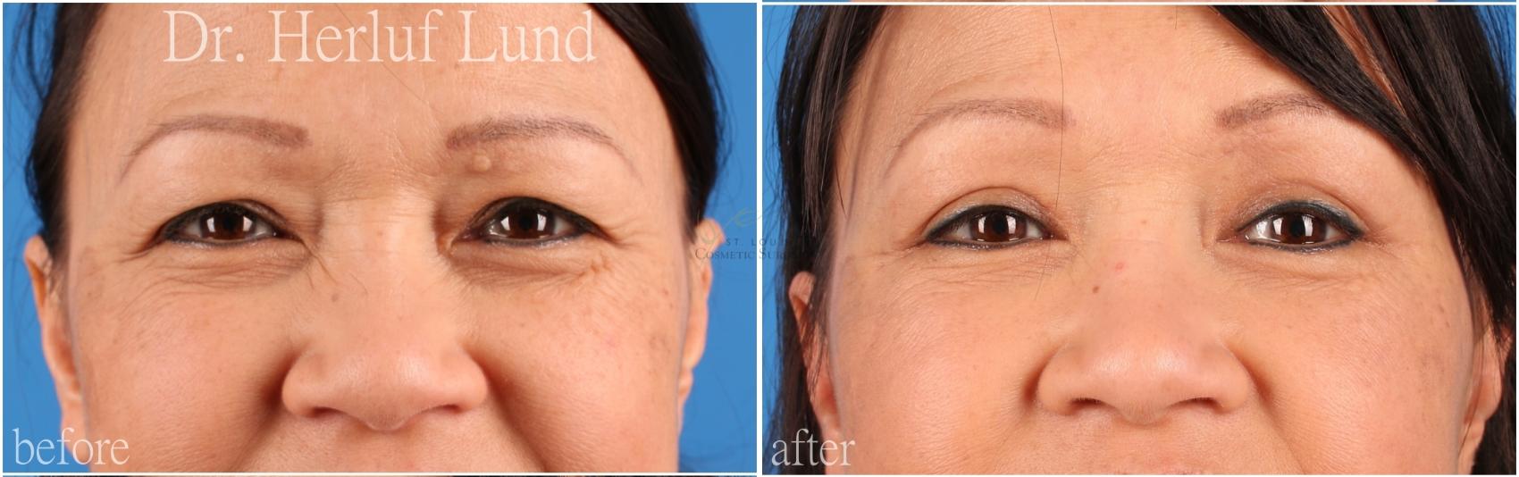 Before & After Eyelid Surgery Case 438 Front View in St. Louis, MO