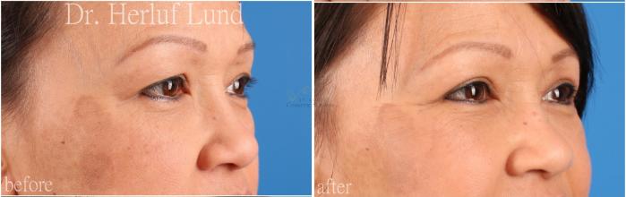 Before & After Eyelid Surgery Case 438 Right Oblique View in St. Louis, MO