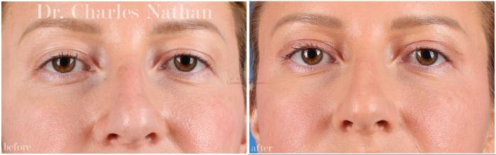 Before & After Eyelid Surgery Case 451 Front View in St. Louis, MO