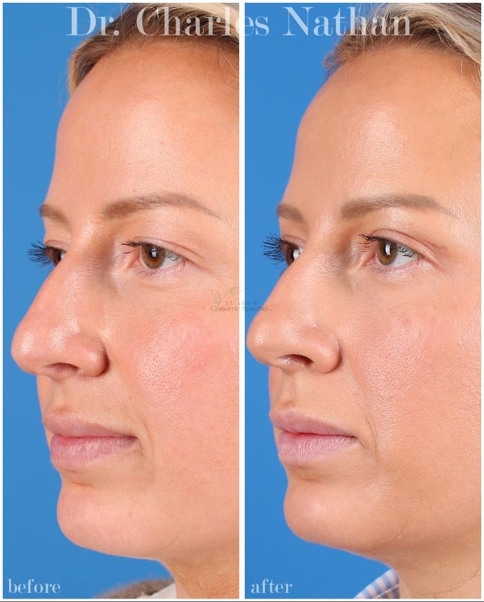 Before & After Eyelid Surgery Case 451 Left Oblique View in St. Louis, MO