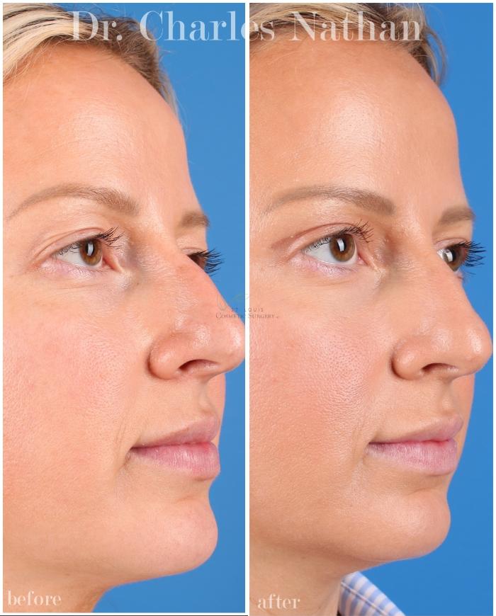 Before & After Eyelid Surgery Case 451 Right Oblique View in St. Louis, MO