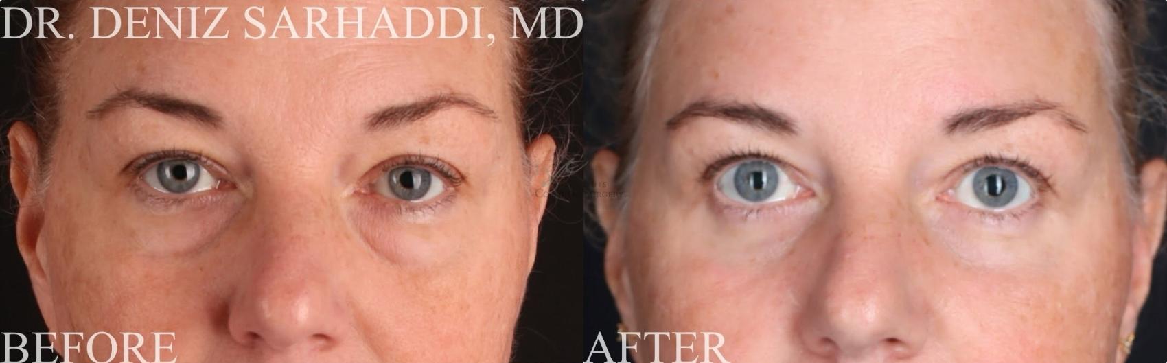 lower blepharoplasty and fat transposition