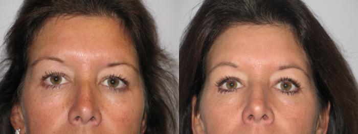 Before & After Eyelid Surgery Case 51 View #1 View in St. Louis, MO