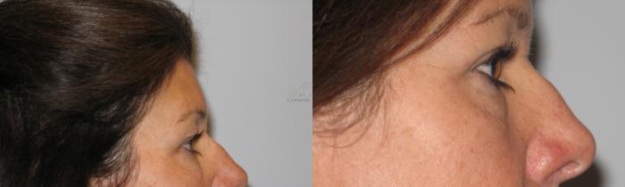 Before & After Eyelid Surgery Case 51 View #2 View in St. Louis, MO