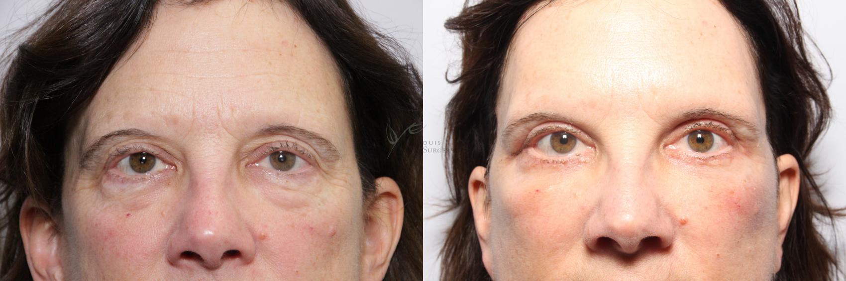 Before & After Eyelid Surgery Case 95 View #1 View in St. Louis, MO