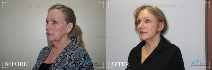 Before & After Neck Lift Case 281 Left Oblique View in St. Louis, MO