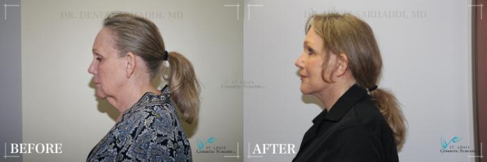 Before & After Neck Lift Case 281 Left Side View in St. Louis, MO