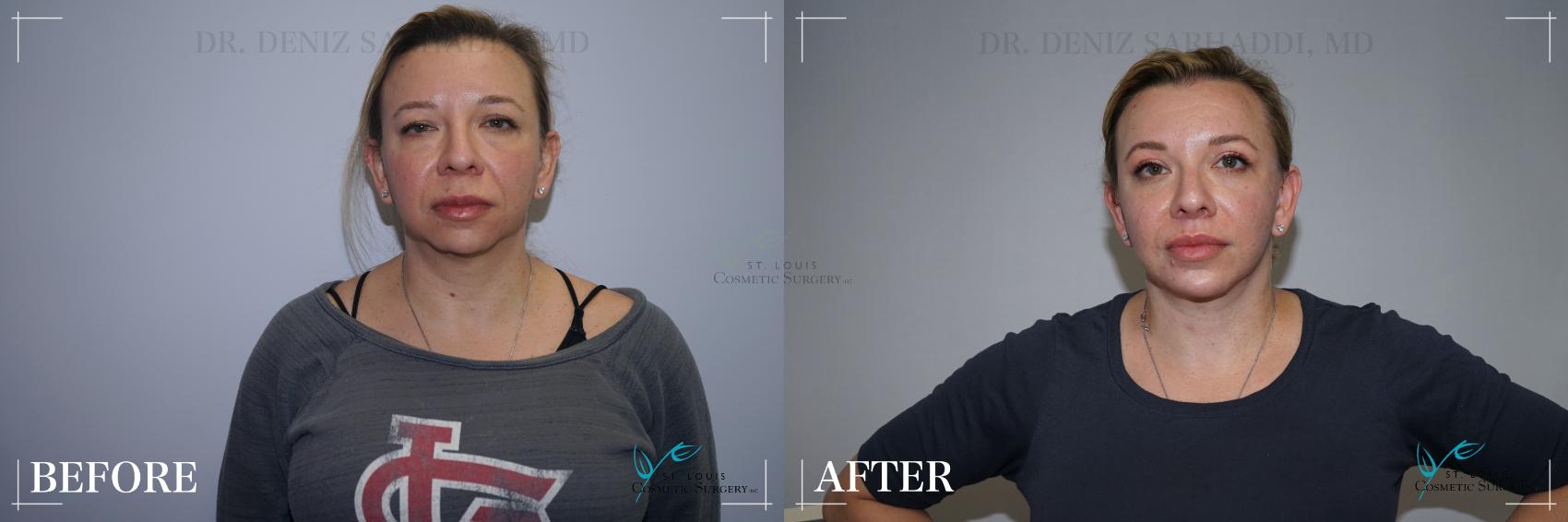 Before & After Chin Enhancement Case 282 Front View in St. Louis, MO