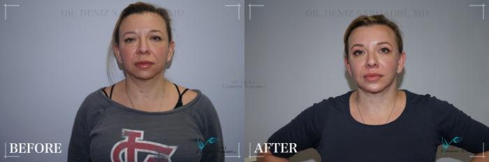 Before & After Neck Lift Case 282 Front View in St. Louis, MO