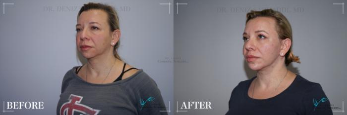 Before & After Neck Lift Case 282 Left Oblique View in St. Louis, MO