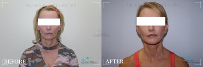 Before & After Facial Fillers Case 283 Front View in St. Louis, MO