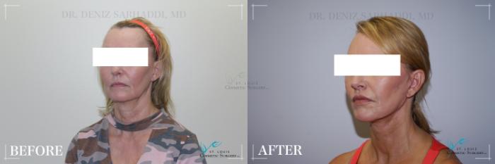 Before & After Neck Lift Case 283 Left Oblique View in St. Louis, MO