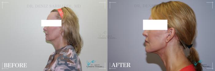 Before & After Neck Lift Case 283 Left Side View in St. Louis, MO