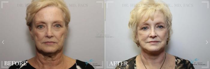 Before & After Facelift Case 324 View #1 View in St. Louis, MO