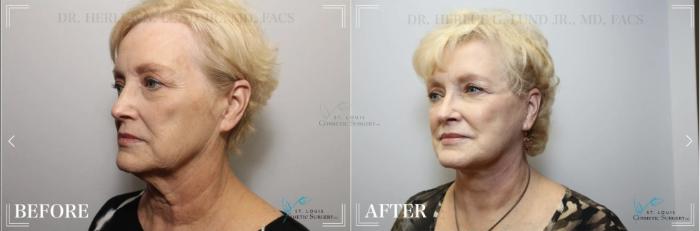 Before & After Eyelid Surgery Case 324 View #2 View in St. Louis, MO