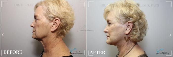 Before & After Eyelid Surgery Case 324 View #3 View in St. Louis, MO