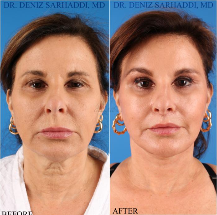 Before & After Facelift Case 343 Front View in St. Louis, MO