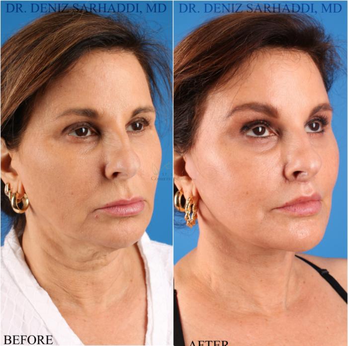 Before & After Facelift Case 343 Left Oblique View in St. Louis, MO