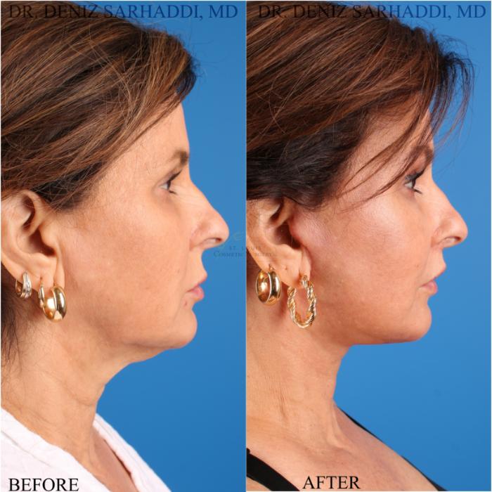 Before & After Facelift Case 343 Left Side View in St. Louis, MO