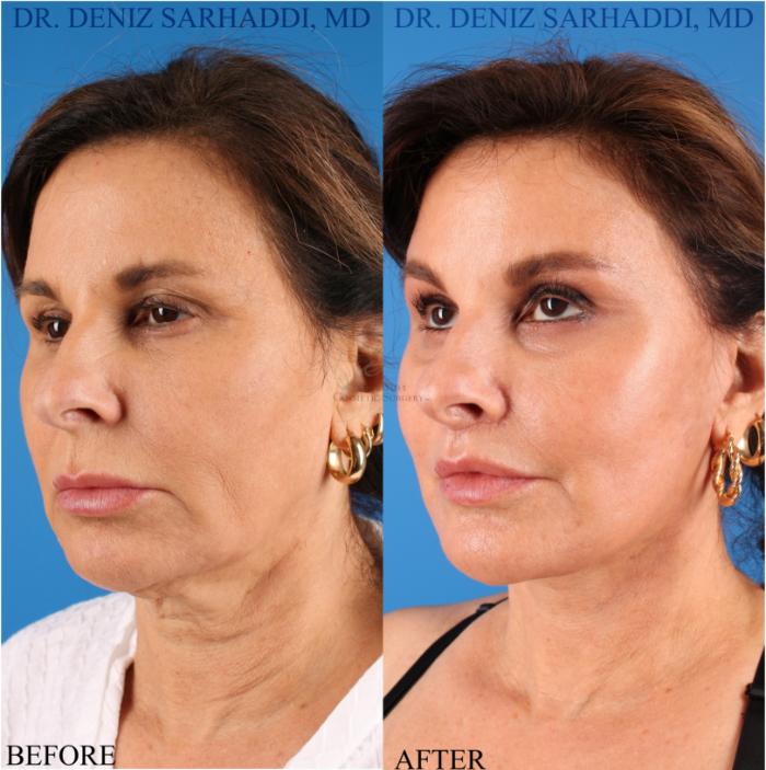 Before & After Facelift Case 343 Right Oblique View in St. Louis, MO