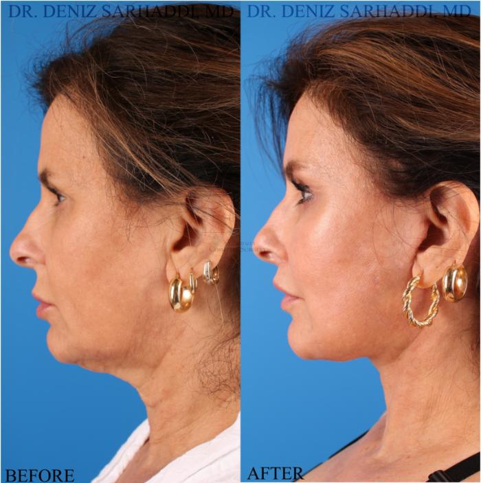 Before & After Facelift Case 343 Right Side View in St. Louis, MO