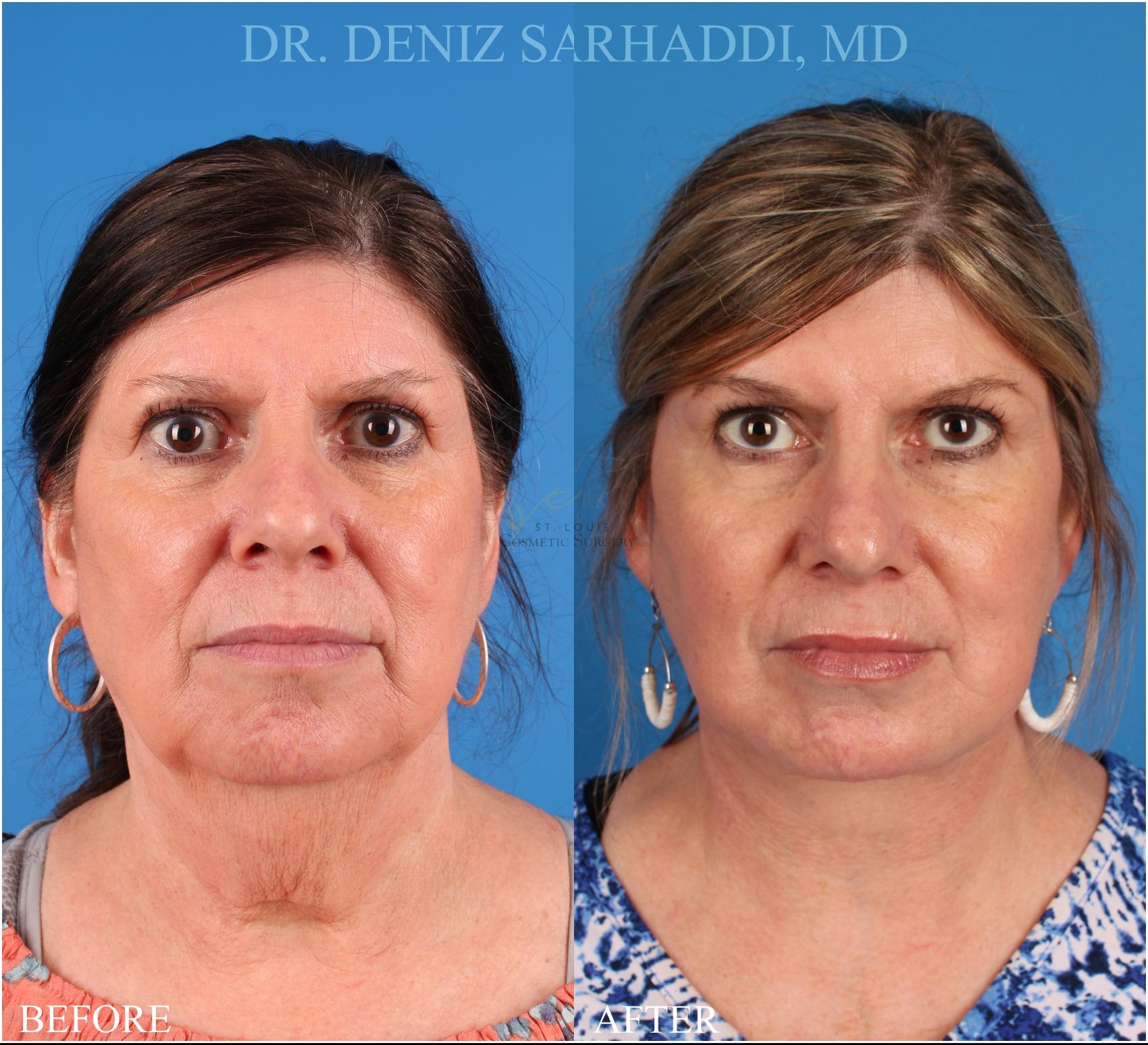 Before & After Facelift Case 344 Front View in St. Louis, MO