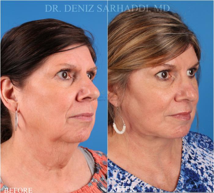 Before & After Facelift Case 344 Left Oblique View in St. Louis, MO