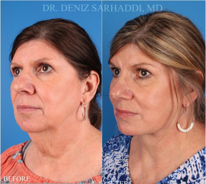 Before & After Facelift Case 344 Right Oblique View in St. Louis, MO