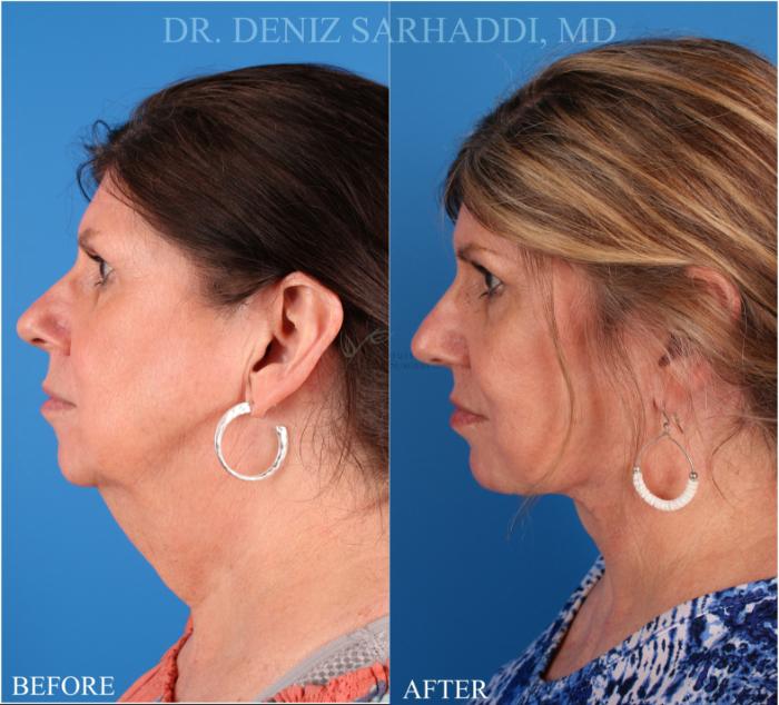 Before & After Facelift Case 344 Right Side View in St. Louis, MO