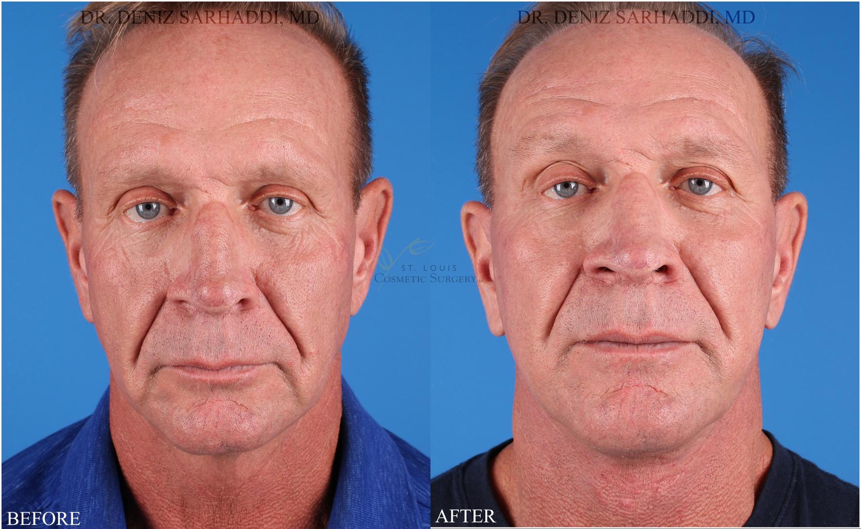 Before & After Facelift Case 345 Front View in St. Louis, MO