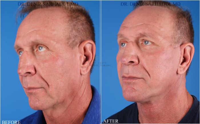 Before & After Neck Lift Case 345 Right Oblique View in St. Louis, MO