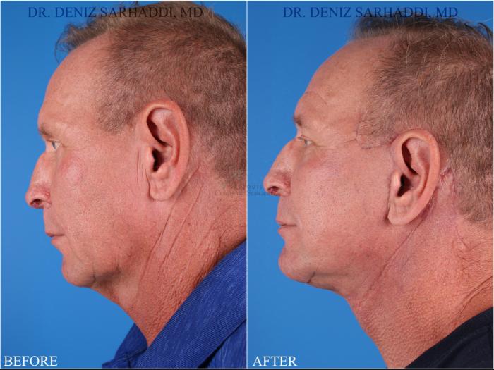 Before & After Neck Lift Case 345 Right Side View in St. Louis, MO