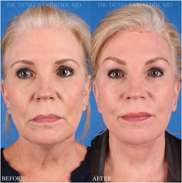 Before & After Neck Lift Case 346 Front View in St. Louis, MO