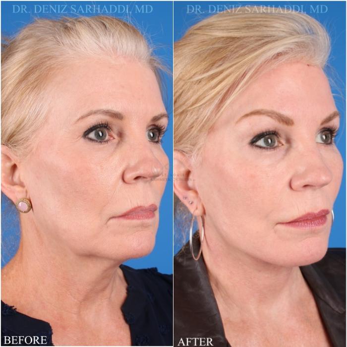 Before & After Facelift Case 346 Left Oblique View in St. Louis, MO