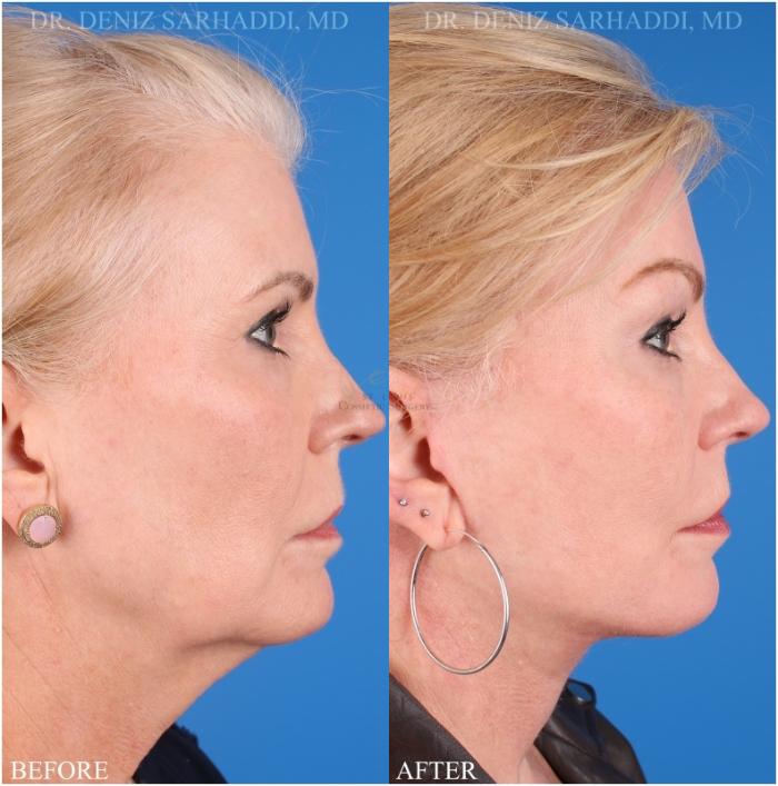 Before & After Facelift Case 346 Left Side View in St. Louis, MO