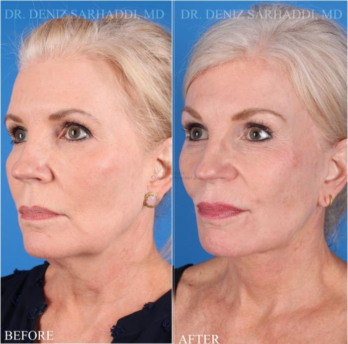 Before & After Facelift Case 346 Right Oblique View in St. Louis, MO