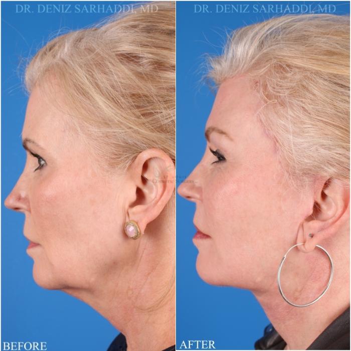 Before & After Facelift Case 346 Right Side View in St. Louis, MO