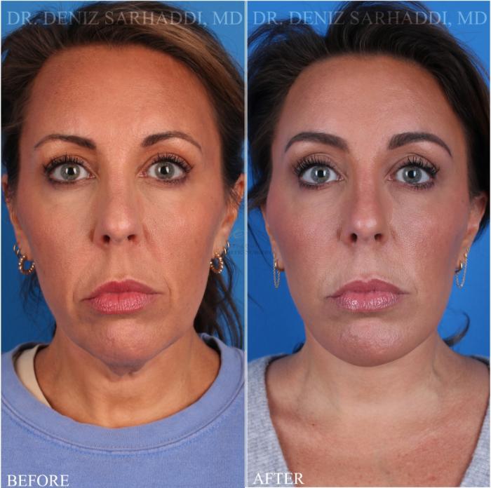 Before & After Facelift Case 347 Front View in St. Louis, MO