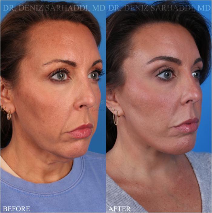 Before & After Neck Lift Case 347 Left Oblique View in St. Louis, MO