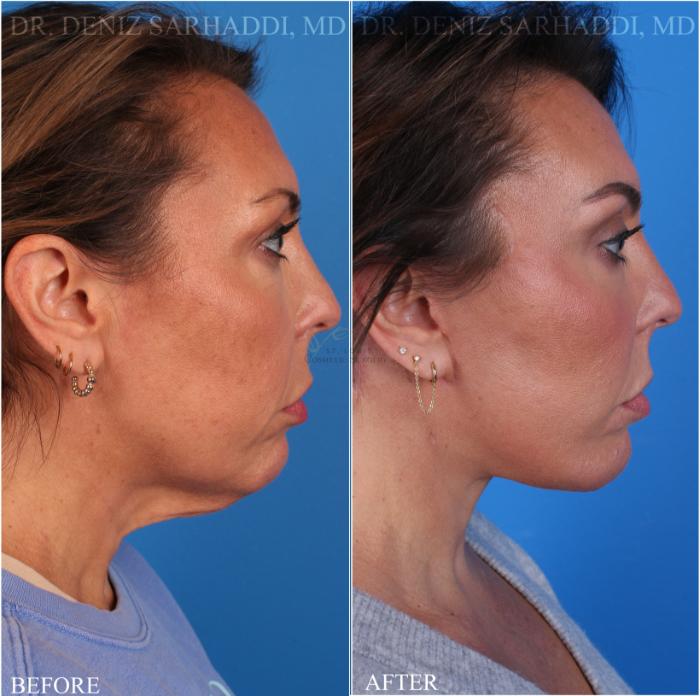 Before & After Neck Lift Case 347 Left Side View in St. Louis, MO