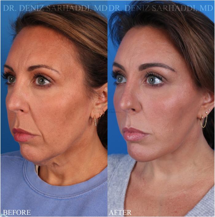 Before & After Facelift Case 347 Right Oblique View in St. Louis, MO